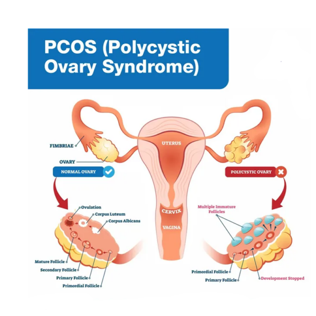 Polycystic Ovarian Disease (Pcod): What Is Pcod?