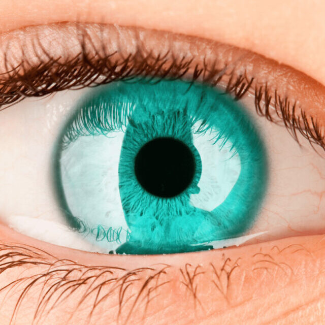 cataract is a clouding of the normally clear lens of the eye.