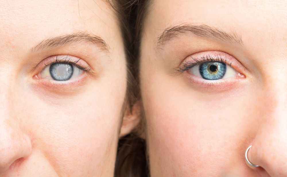 मोतियाबिंद (Cataracts)