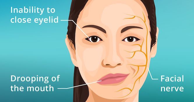 Bell’s Palsy