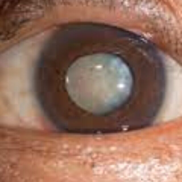 मोतियाबिंद (Cataracts)