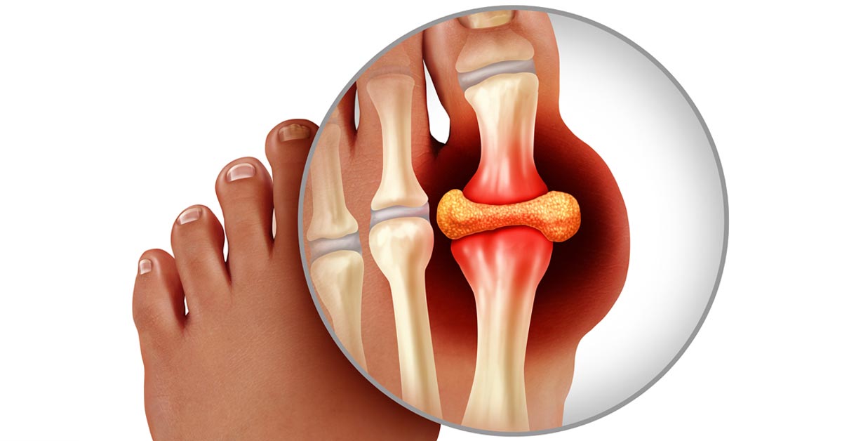 गाउट (Gout)